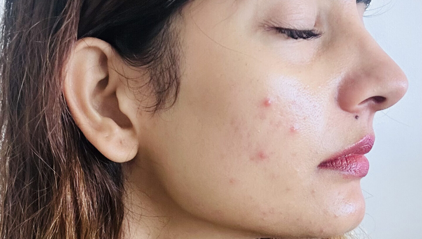 Understanding Your Acne: Types and Root Causes