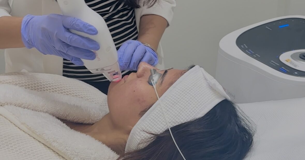 Treating Acne with LASEMD at Modern Aesthetics